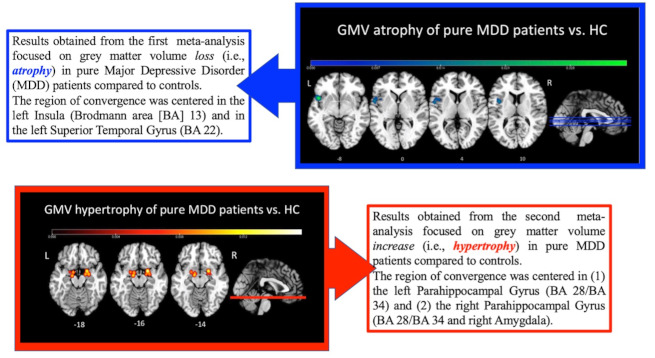 The dark and gloomy brain: grey matter volume alterations in major depressive disorder – fine-grained meta-analyses