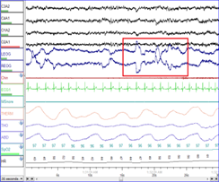 Psychophysiology of sleep